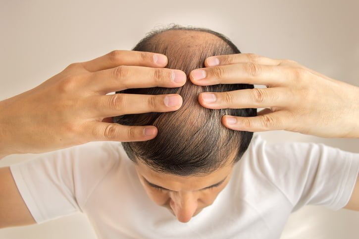 permanent-hair-loss-caused-by-taxotere-grounds-oxner-permar